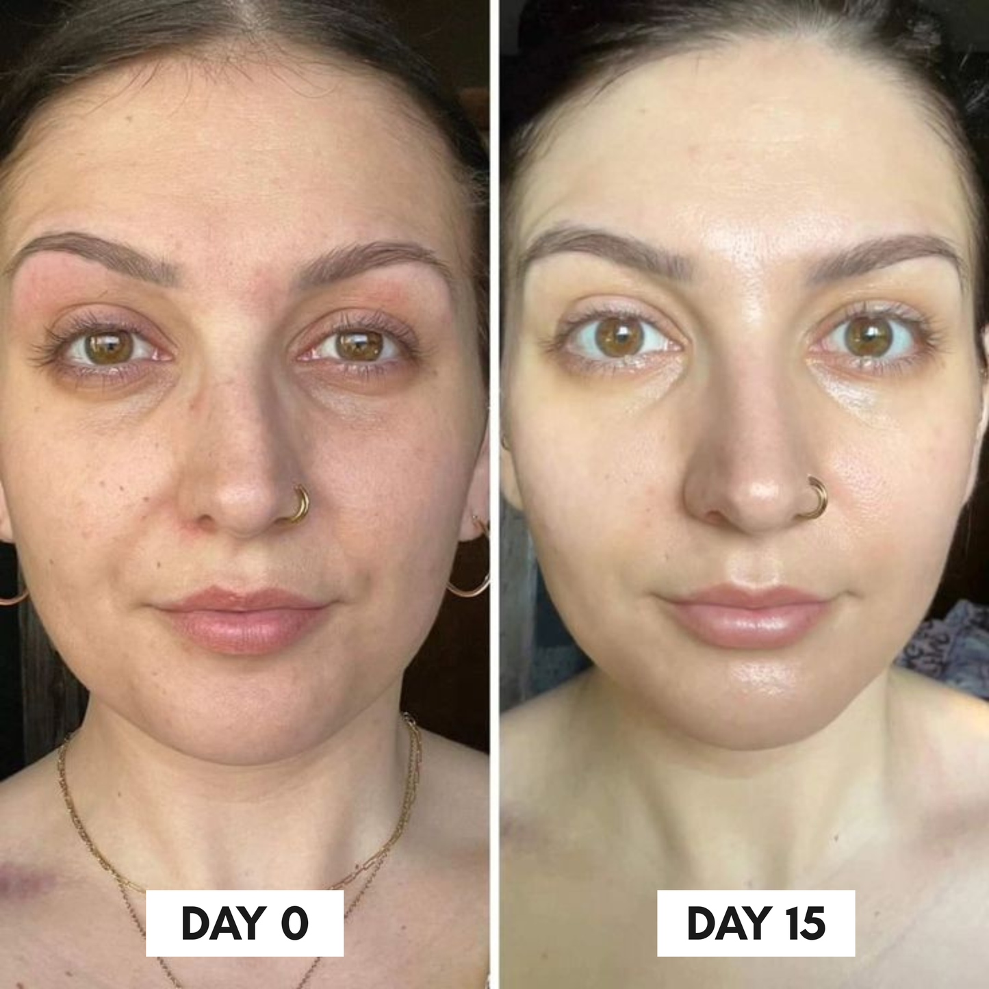 Clinical Grade Filler-like results in just 2 weeks